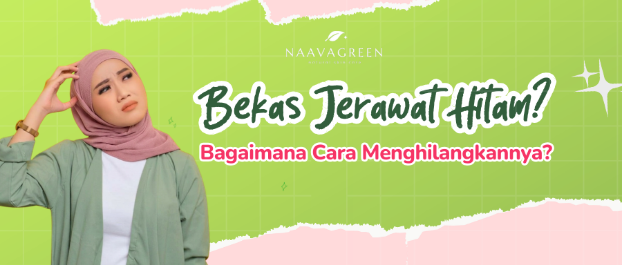 Bekas Jerawat Hitam Bagaimana Cara Menghilangkannya?
