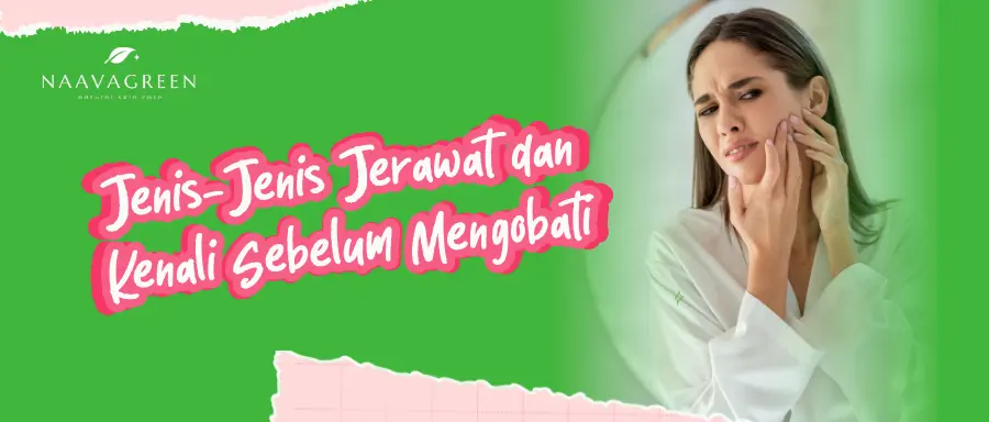 Jenis-Jenis Jerawat dan Gambarnya: Kenali Sebelum Mengobati
