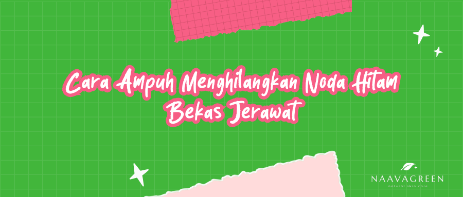 Cara Ampuh Menghilangkan Noda Hitam Bekas Jerawat